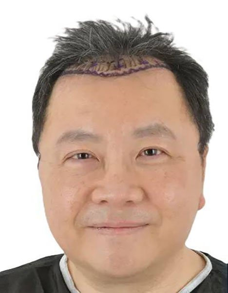 Before treatment